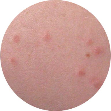 Skin rash caused by bed bugs.